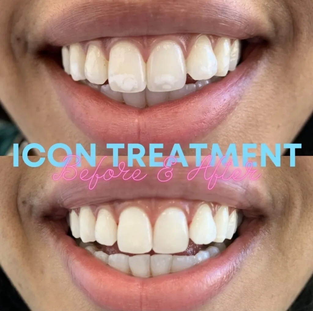 33221 microabrasion teeth