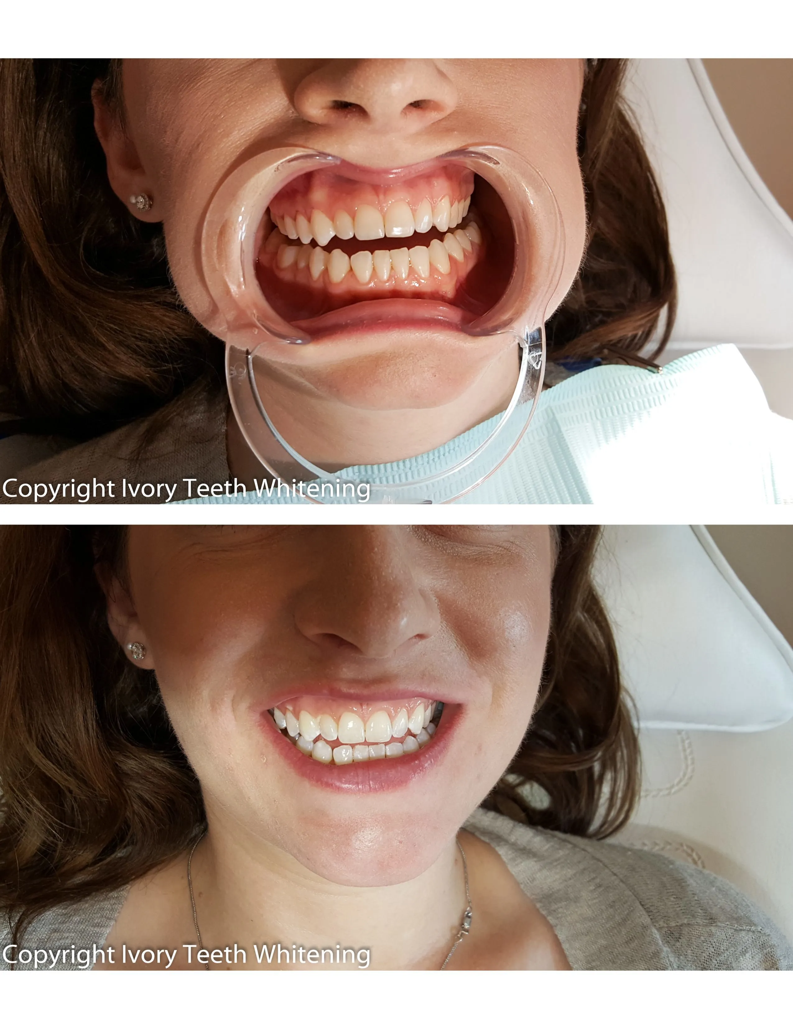 33224 cost effective teeth whitening