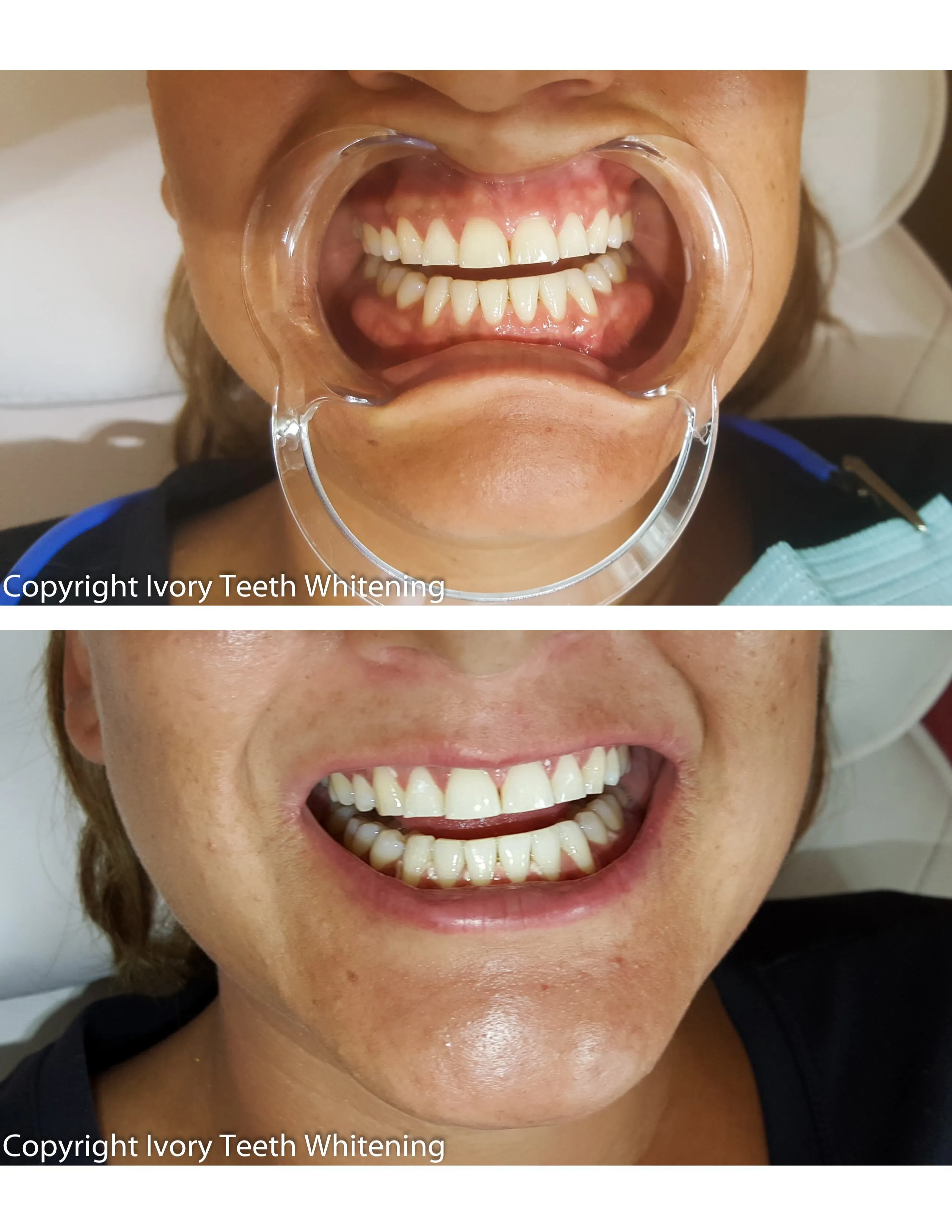 33224 easy to use teeth whitening