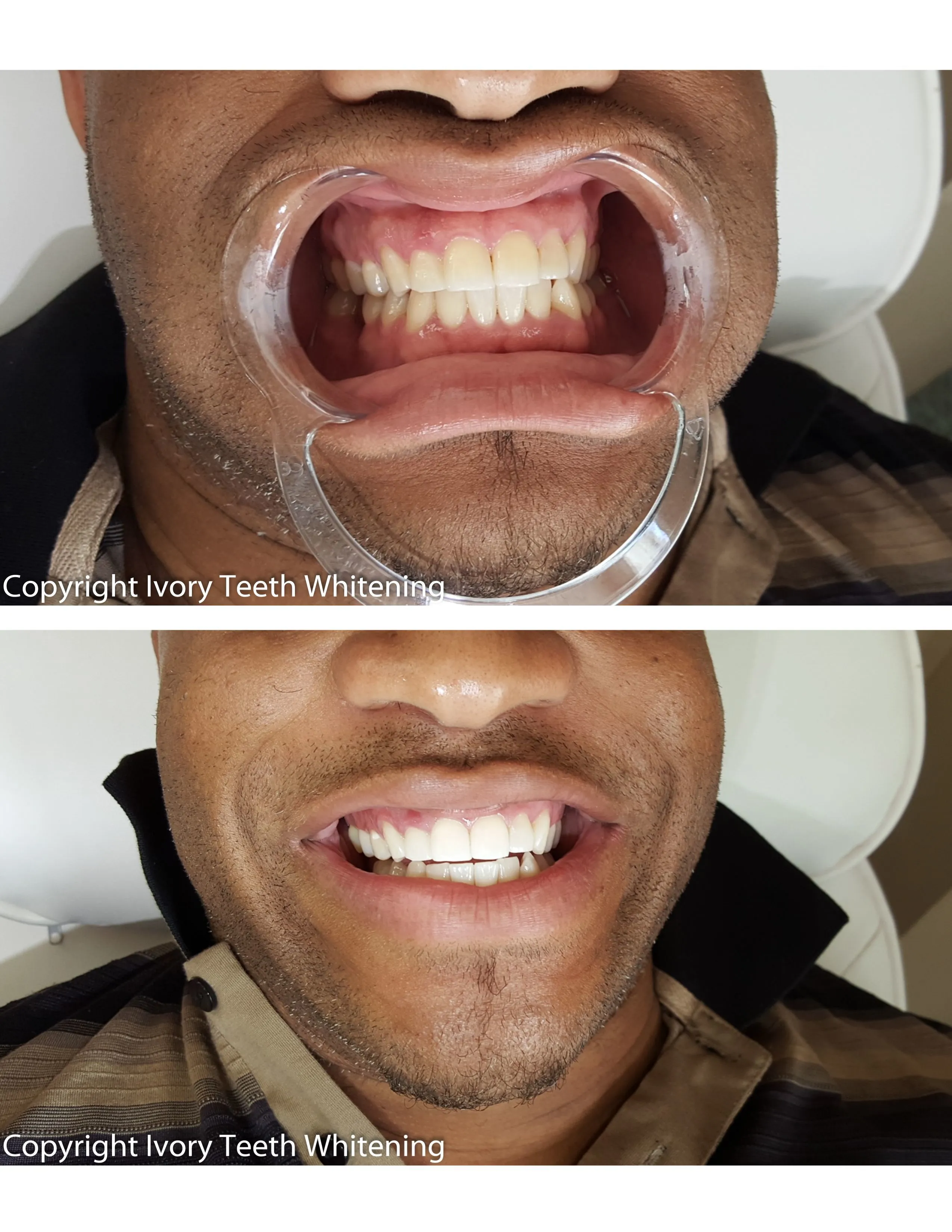 33224 teeth enamel safety