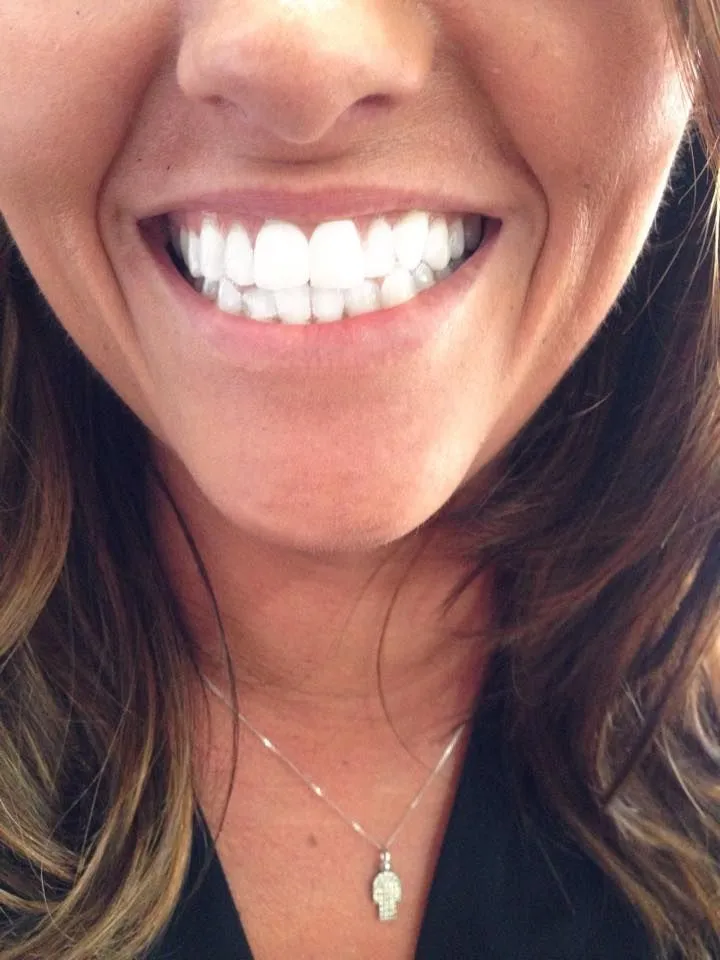33224 teeth whitening sensitivity